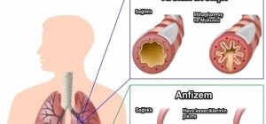 Nefesiniz Daralıyorsa KOAH Olabilirsiniz!