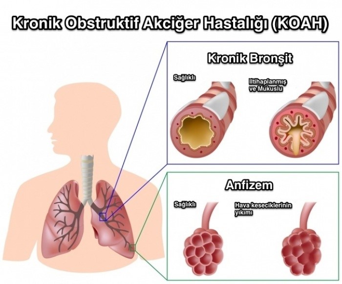 Nefesiniz Daralıyorsa KOAH Olabilirsiniz!