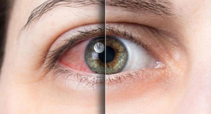 Aman dikkat! Gözdeki kaşıntının nedeni bu olabilir